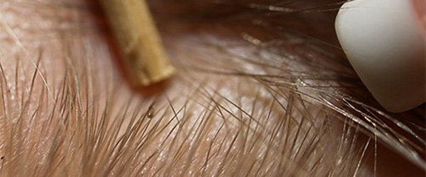 Вши у детей: как появляются и как с ними бороться 4